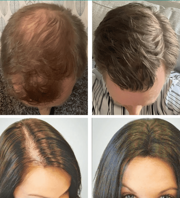 Hairoxol Forte Haarvitamine Kapseln